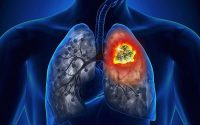 Cách phòng ngừa ung thư phổi