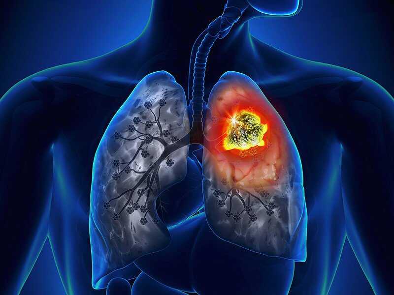 Cách phòng ngừa ung thư phổi