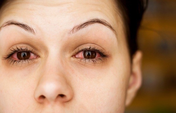 Bệnh khô mắt là gì