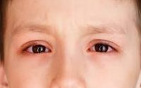 Bệnh khô mắt là gì? Nguyên nhân triệu chứng và cách điều trị