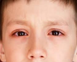 Bệnh khô mắt là gì? Nguyên nhân triệu chứng và cách điều trị